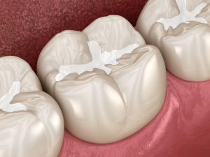 How dental fillings work - dentist in Manhattan, KS