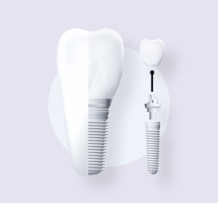 Dental implants in Manhattan, KS