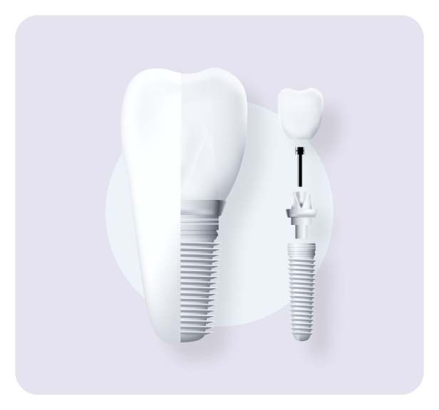 Dental implants at Downtown Dental Group