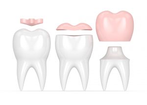 Illustration of dental inlays and onlays, showcasing different shapes and sizes of tooth restorations for repairing damaged teeth while preserving natural tooth structure.