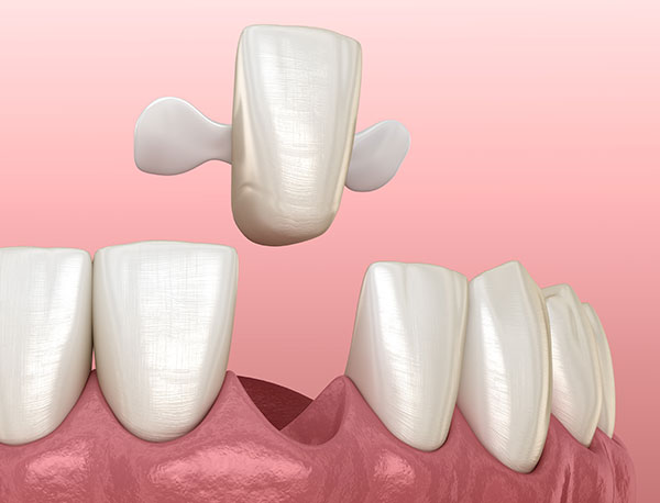 illustration of maryland dental bridge