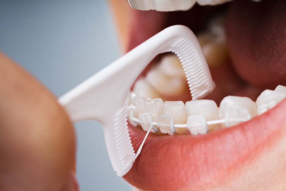 woman uses floss pick to clean white braces
